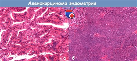 Аденокарцинома