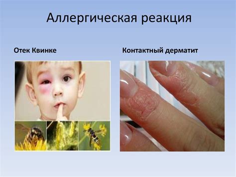 Аллергические реакции на фитонциды еловой ветки
