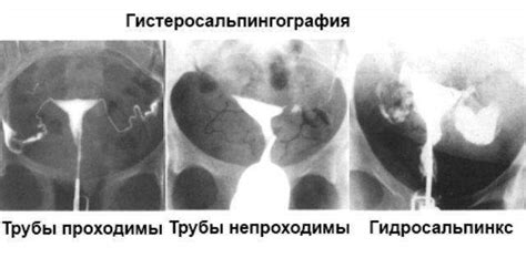 Альтернативные методы для диагностики проблем с проходностью маточных труб