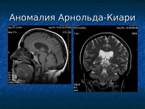 Аномалии позиционирования клубочков головного мозга: признаки и последствия