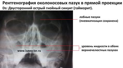 Аномальное увеличение слизистой верхнечелюстной пазухи: причины и симптомы