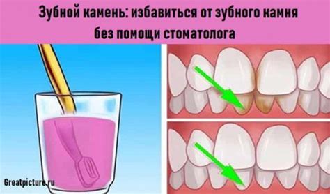 Важные моменты в восстановлении зубной протезирующей системы без помощи стоматолога