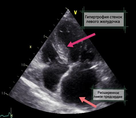 Важные советы для пациентов с значительными изменениями стенок левого желудочка