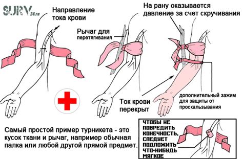 Варианты процедур для закрепления отсоединенной конечности