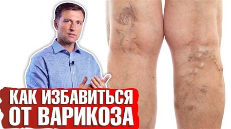Варикозное расширение вен: особенности и последствия