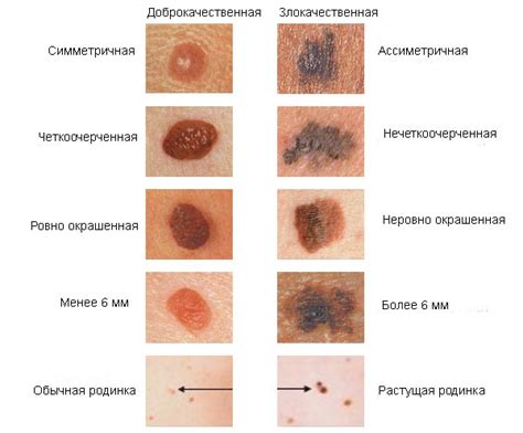 Взаимодействие соляриев и родинок: научные факты и расхожие мнения