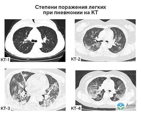 Вирусная пневмония 3 степени