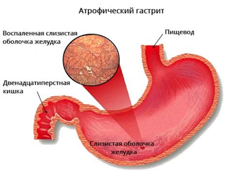 Влияние белка на процесс заживления расстройства слизистой оболочки желудка