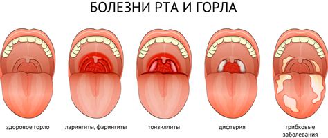 Влияние заболеваний горла на неприятный запах изо рта