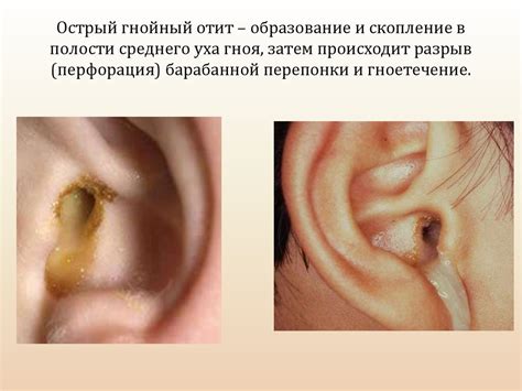 Влияние использования аудио-устройств на процесс восстановления при воспалении среднего уха