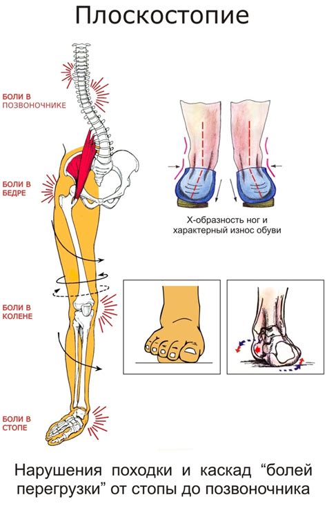 Влияние плоскостопия на здоровье нижних конечностей: причины и последствия