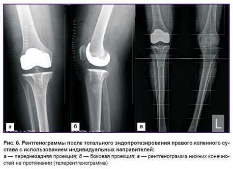 Влияние позиции при рождении на формирование структуры коленного сустава у младенцев