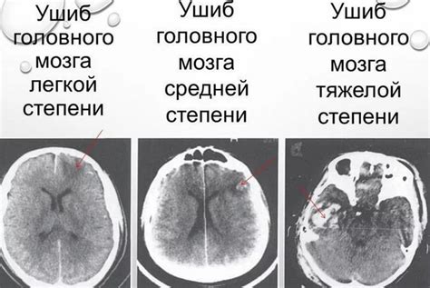 Влияние сотрясения мозга на другие аспекты зрительной функции