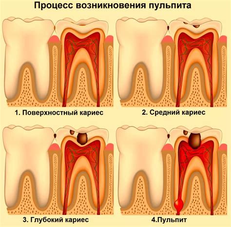 Влияние удаления нерва на чувствительность зуба и окружающих тканей