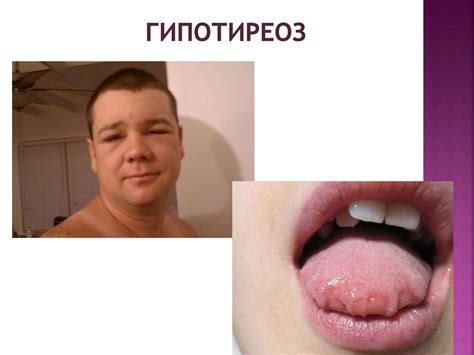 Внешние проявления резкого отравления тиурамами