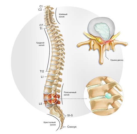 Воздействие грыжи позвоночника на организм: последствия и влияние на здоровье