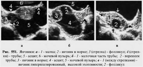 Возможные искажения результатов ультразвукового исследования после вакцинации против АДСМ