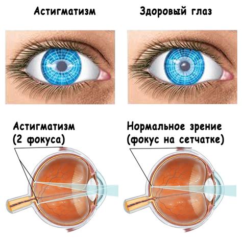 Возможные осложнения и риски при замене линзы внутри глаза