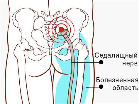 Возможные осложнения при сжатии седалищного нерва