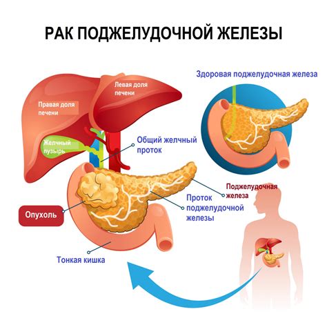 Возможные причины изменения поджелудочной железы