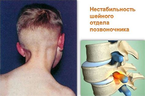Возможные проблемы с балансом и ощущениями неустойчивости при нестабильности шейных позвонков