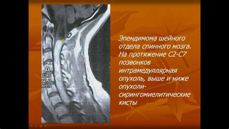 Возможный риск заражения при проведении процедуры точкирования спинного мозга