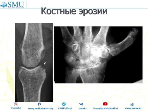 Воспалительные заболевания суставов и их последствия