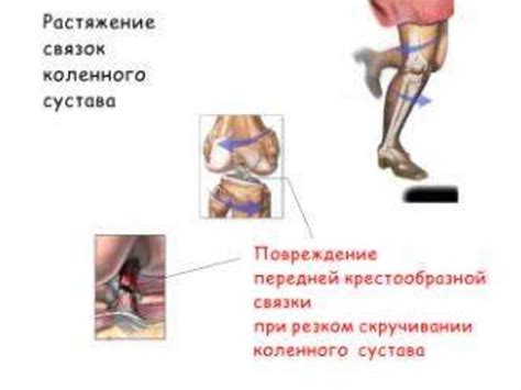 Восстановление после повреждений связок колена: роль плавания в реабилитации