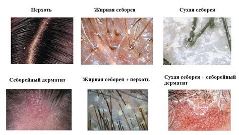 Вторичная причина сухости – перхоть и себорейный дерматит