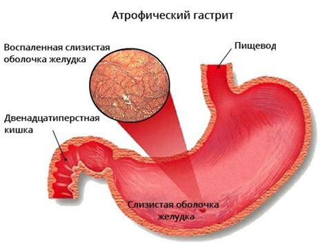 Гастрит: воспаление желудочной слизистой оболочки с присутствием крови