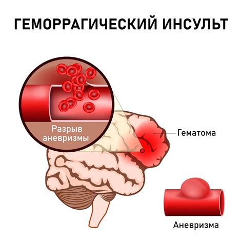 Геморрагический инсульт: особенности и признаки