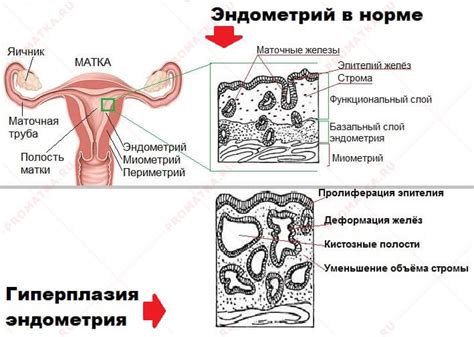 Гиперплазия эндометрия: понятие и суть