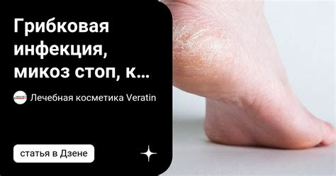 Грибковая инфекция: возможная причина зуда и покраснения стопы