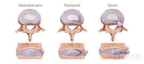 Грыжа позвоночного диска: основные характеристики и причины