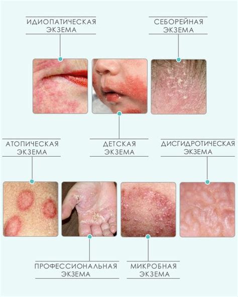Дерматит и экзема как потенциальные причины покраснения и чувства дискомфорта