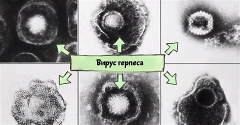 Диагностика вируса НТУ-1