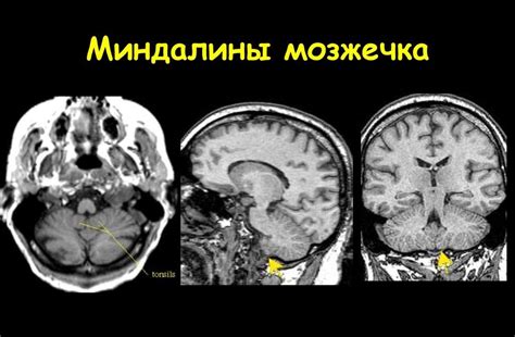 Диагностика и лечение несоответствий в позиции миндалин мозжечка