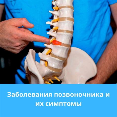 Диагностика нарушения положения позвонков в области поясницы: как распознать и понять проблему