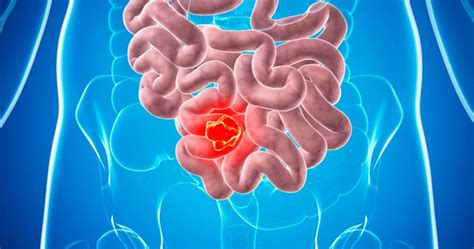 Диагностика новообразования в кишечнике