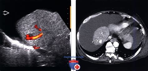 Диагностика новообразования с кровотоком