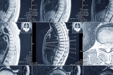 Диагностика опухоли позвоночника: методы и сложности