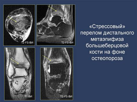 Диагностика трещин локтевого сустава при помощи магнитно-резонансной томографии