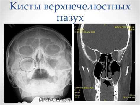 Диагностика утолщения слизистой правой верхнечелюстной пазухи: основные методы и исследования