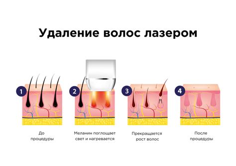 Длительность возобновления волосного покрова после процедуры лазерной эпиляции