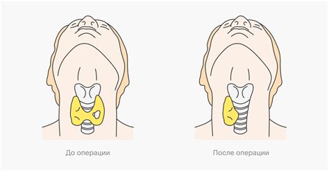 Значение и обнаружение узлов на щитовидной железе