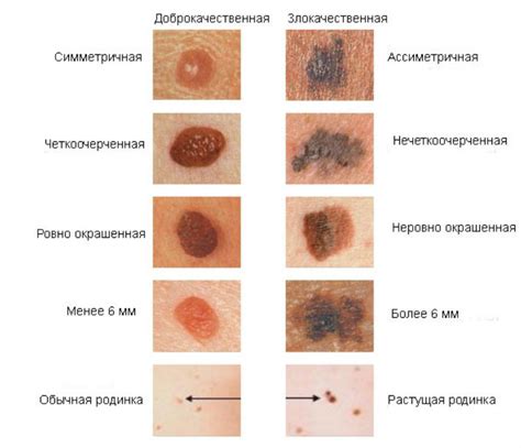 Значение родинок в контексте вероятности развития опасных новообразований