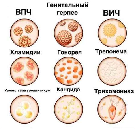 Идентификация сифилиса с помощью выделений из половых органов