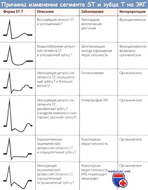 Изменения на электрокардиограмме при неспецифической депрессии ST