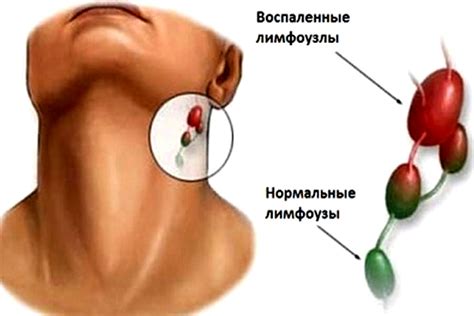 Иные факторы, вызывающие воспаление лимфоузлов