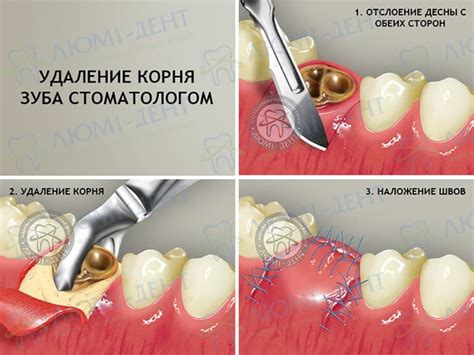 Использование физических методов удаления видимых корней